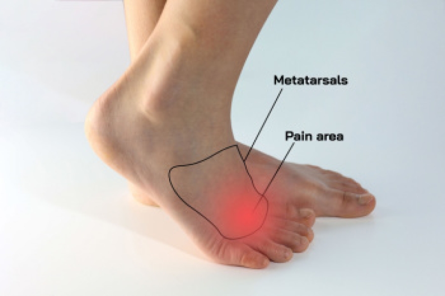 Morton’s Neuroma And Flat Feet